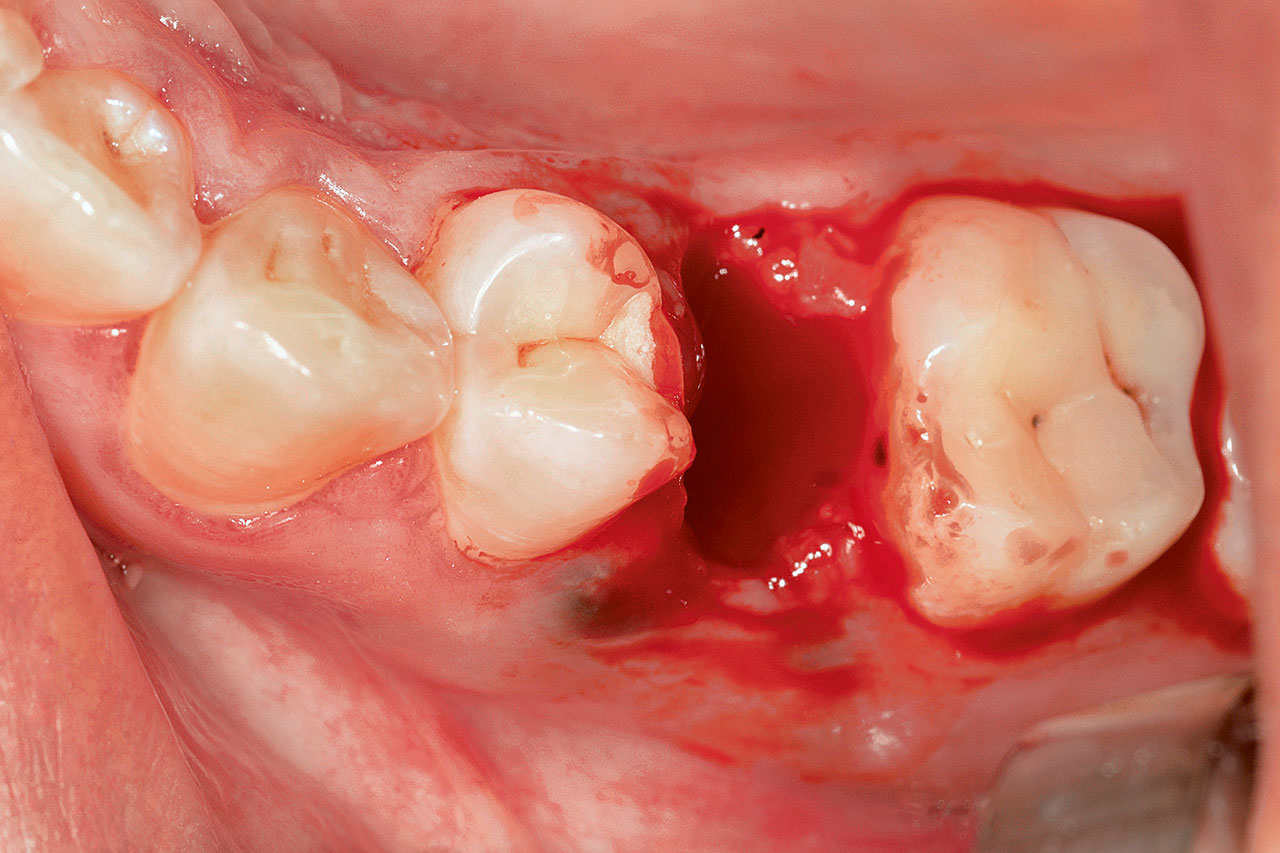 Abb. 3 Alveole nach gewebeschonender Entfernung von Zahn 15.