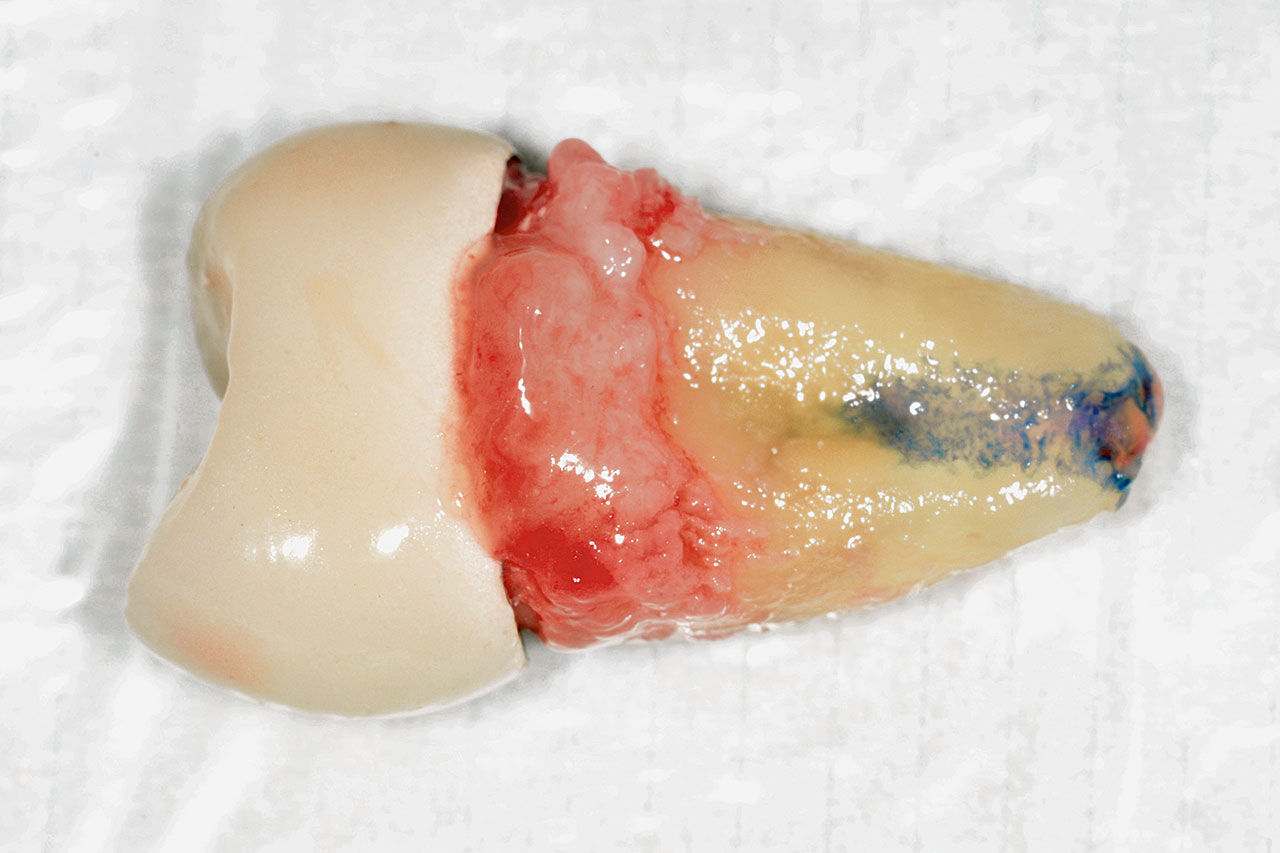 Abb. 5 Die metallkeramische Krone hat sich vom Zahn gelöst. Die Wurzel wurde mit Methylenblau auf eine Längsfraktur untersucht.