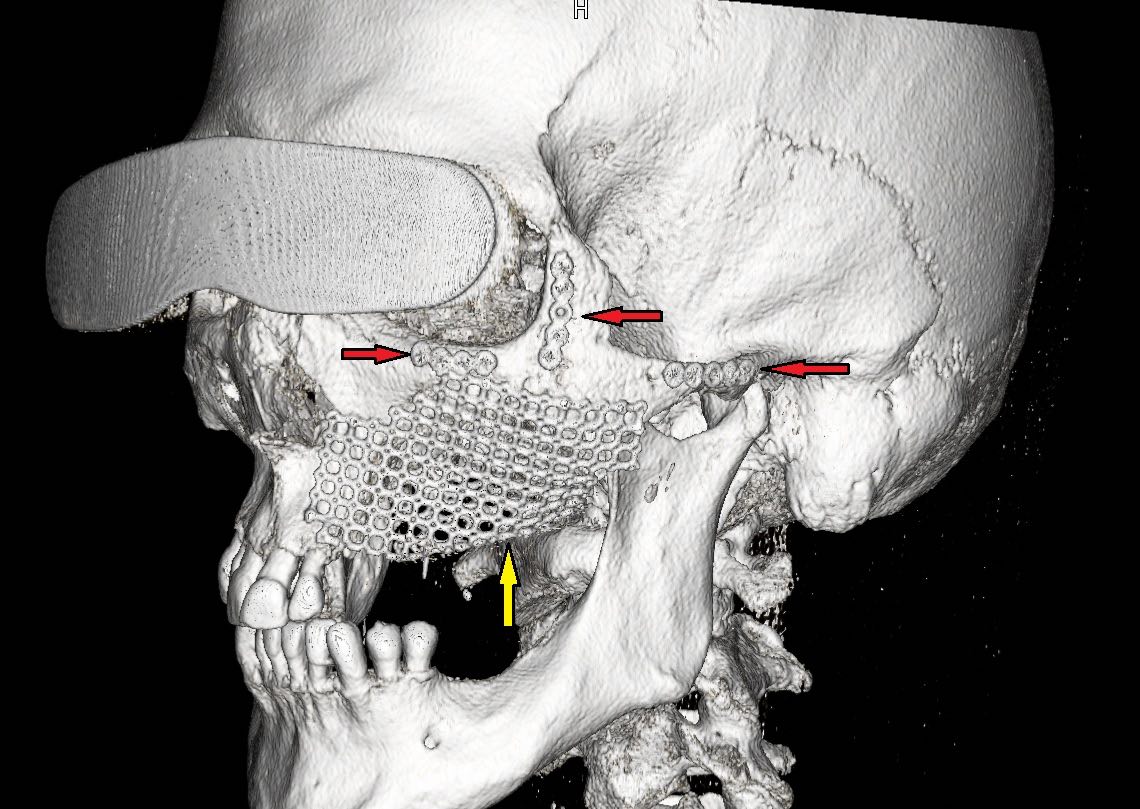 Abb. 5 3-D-Rekonstruktion der postoperativ durchgeführten DVT-Bildgebung mit einliegenden Osteosyntheseplatten im Bereich des refixierten linken Jochbeines (rote Pfeile) und einliegendem Titanmesh zur temporären Rekonstruktion des Resektionsdefektes (gelber Pfeil).