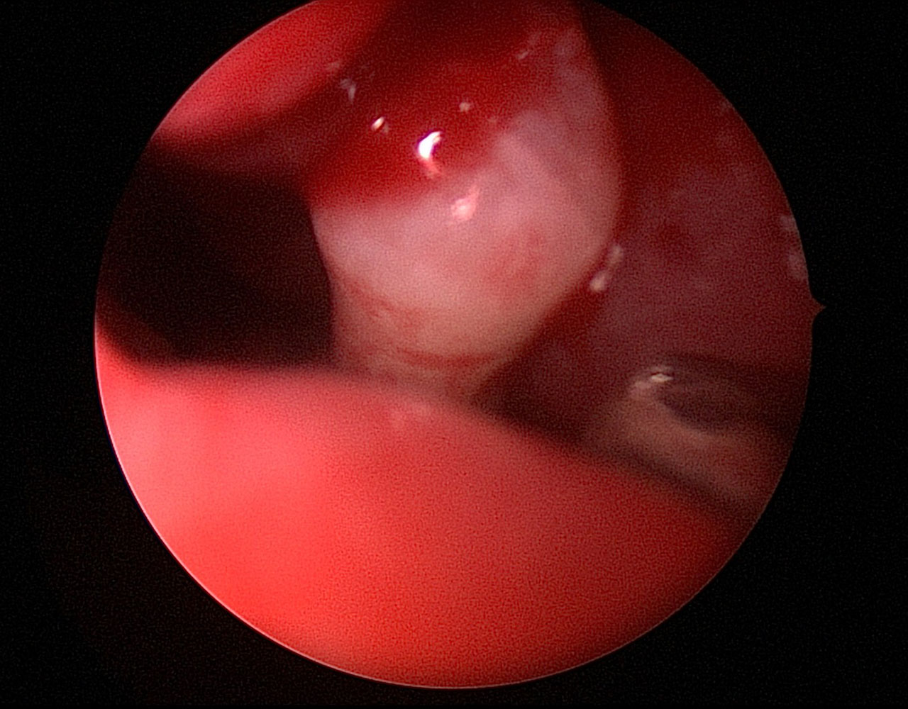 Abb. 4 Endoskopisch durchgeführte Entfernung des Zahns über die Nase.