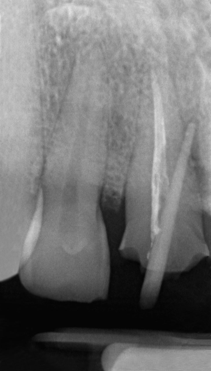 Abb. 1 Das präoperative Röntgenbild zeigt Zahn 11 mit einer insuffizienten, inhomogenen Wurzelfüllung, einem extraaxial inserierten Wurzelstift und einer lateralen Osteolyse.