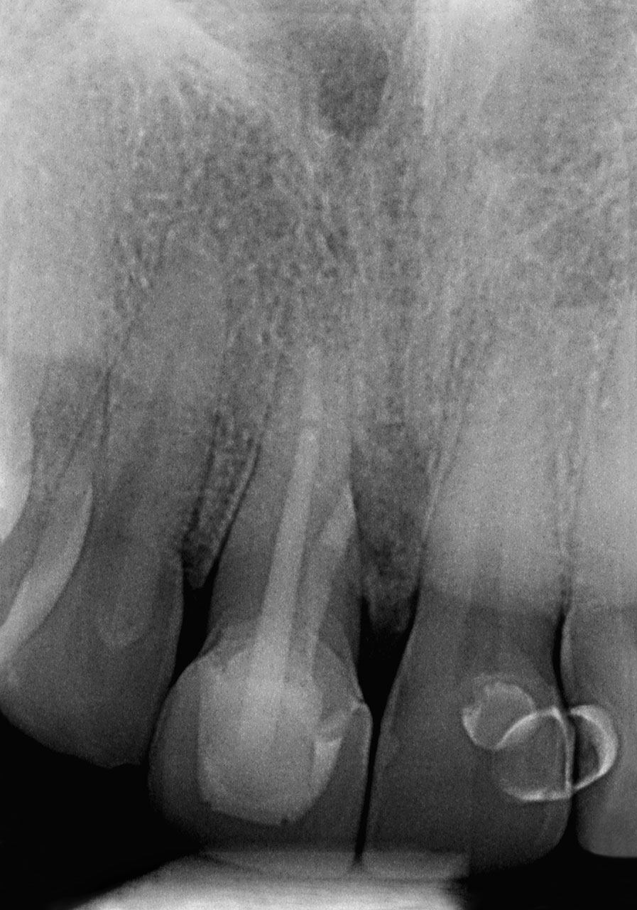 Abb. 18 Die Röntgenkontrolle 16 Monate postoperativ zeigt eine deutliche Reossifikation der lateralen Osteolyse. Der Zahn 11 wurde inzwischen alio loco mit einer IPS e.max-Vollkeramikkrone versorgt.