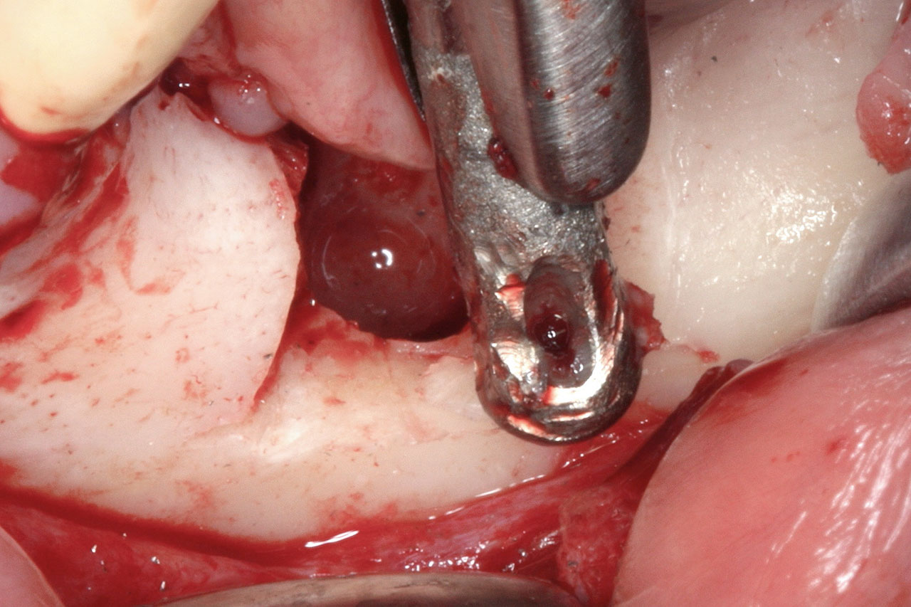 Abb. 6 Explantation des IMZ-Implantats.
