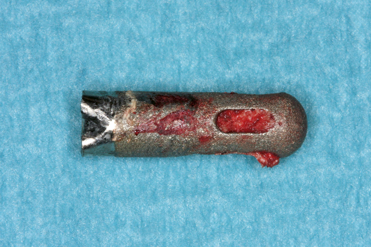Abb. 7 Das entnommene IMZ-Implantat mit dem apikalen Körbchen.