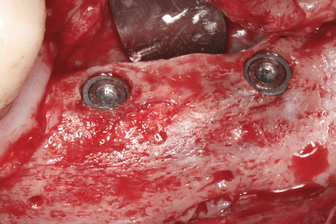 Abb. 18 Inserierte Implantate mit Verschlussschrauben.