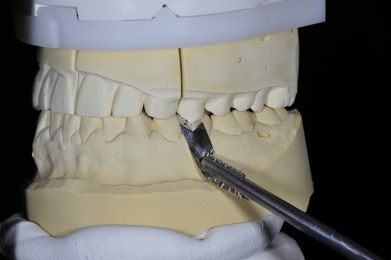 Abb. 2: Umsetzung des Okklusionsprotokolls an den Modellen (Fotos: Jung Dental)