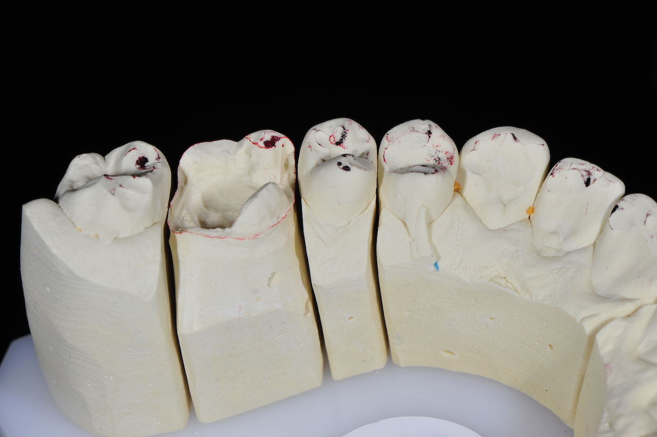 Abb. 6: Detail der Einschleifspuren im Oberkiefer nach dem Einradieren der Modelle mit der Verify-Occlusion-Systematik (Fotos: Jung Dental)