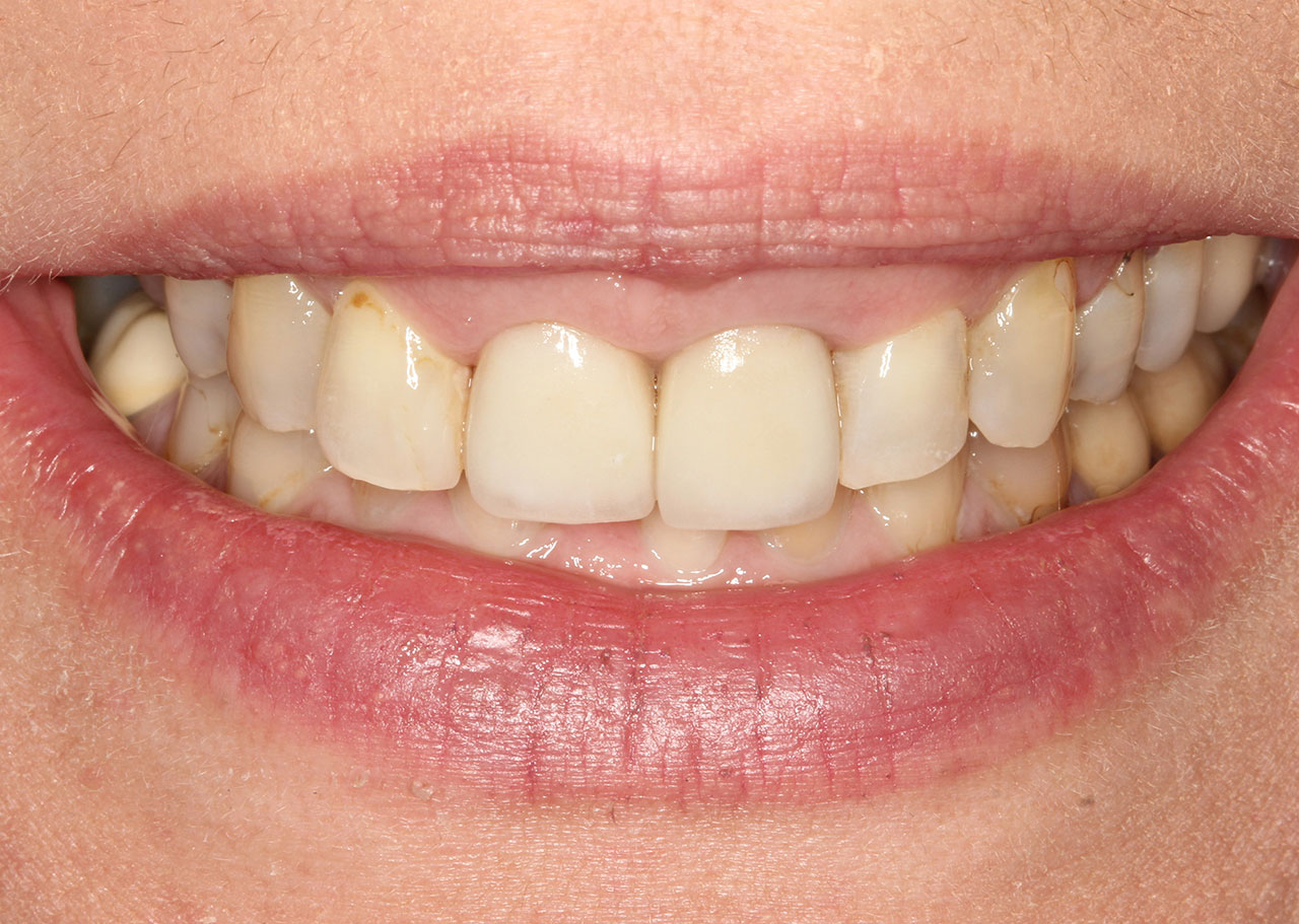 Abb. 1 Eine 42-jährige Patientin mit umfangreichen Restaurationen (vgl. Abb. 2, 3 und 12) wünscht ein Implantat zum Ersatz von Zahn 17.