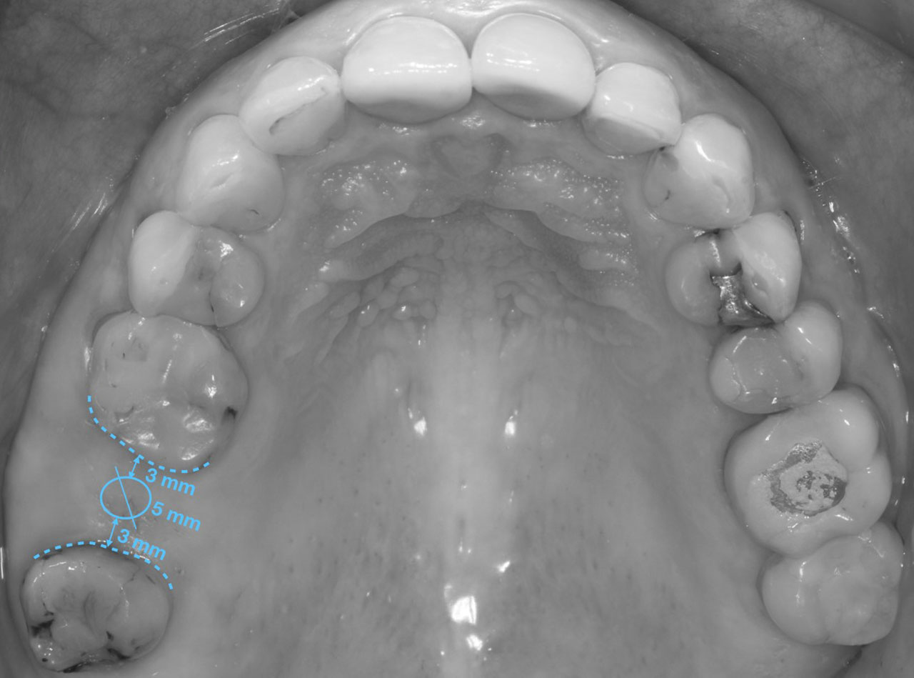 Abb. 2 Die Abmessungen von Zahnlücke, befestigter Mukosa und Alveolarknochen (vgl. Abb. 5) ...