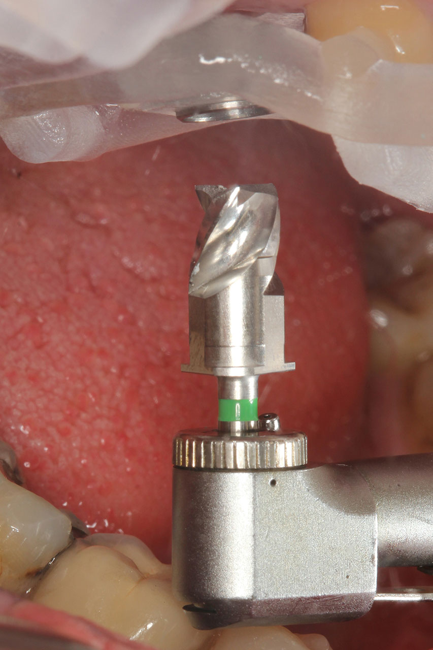 Abb. 10 Die Implantatlager-Aufbereitung durch die Schablone wird mit einem verkürzten Bohrer des finalen Durchmessers eingeleitet. 