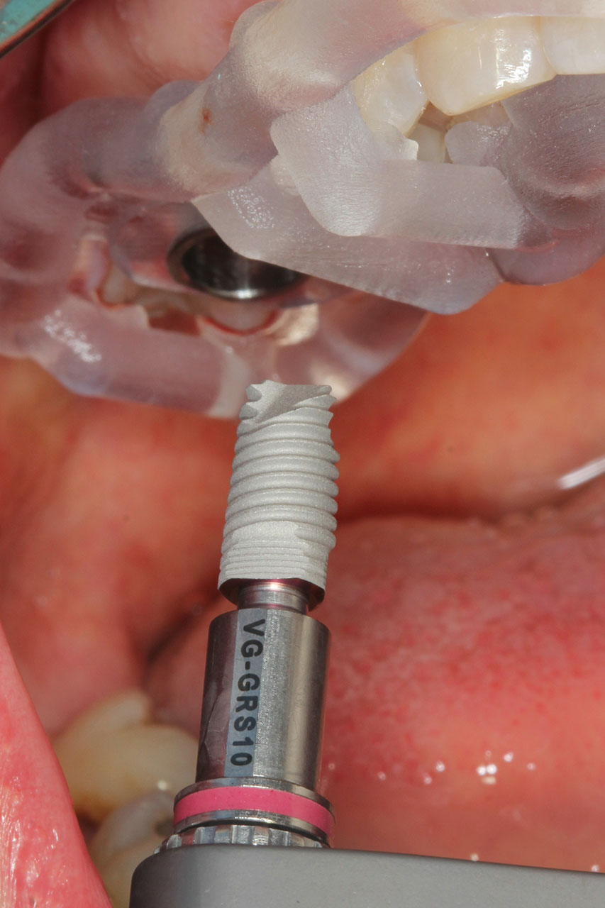 Abb. 11 Nach kompletter Aufbereitung wird das Implantat durch die Bohrschablone inseriert. Gut erkennbar ist die dreieckige Grundform des zervikalen Anteils.