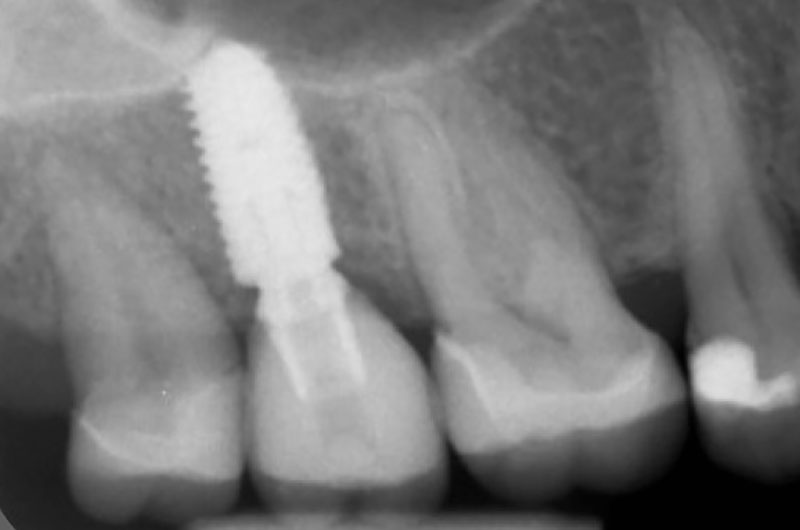 Abb. 19 Der Zahnfilm zeigt eine optimale sagittale Implantatposition, eine korrekt verschraubte Implantatkrone an Position 17 und sauber abschließende adhäsive Teilkronen in den Zähnen 16 und 18.