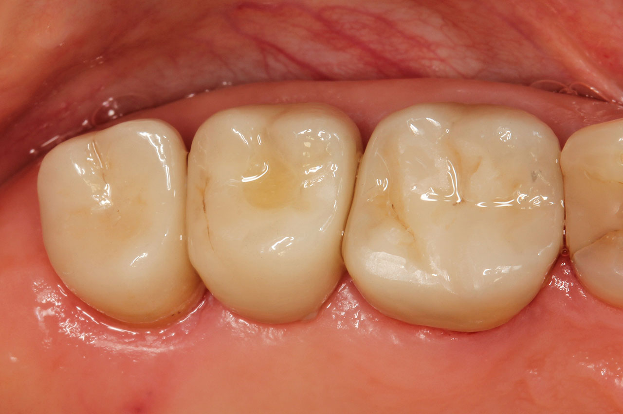 Abb. 20 und 21 Die eingegliederten Kronen sind funktionell, ästhetisch und parodontalhygienisch gelungen. Die Zahnpflege ist weiterhin nicht optimal.