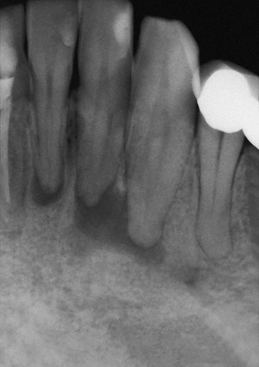 Abb. 1 Bereits das exzentrische präendodontische Röntgenbild zeigt, dass bei den Zähnen 31 bis 33 von je zwei eigenständigen Wurzelkanälen auszugehen ist.