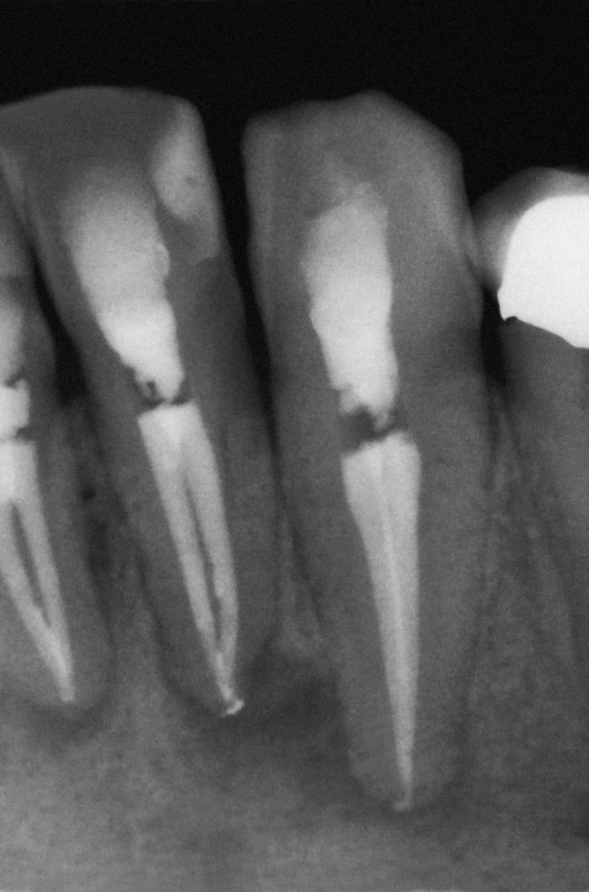 Abb. 2 Für alle drei Zähne konnte eine Konfluenz der beiden Wurzelkanäle in je ein gemeinsames Foramen festgestellt werden. Die Zähne wurden zur Anfertigung der röntgenologischen Kontrollaufnahme vorübergehend provisorisch verschlossen.