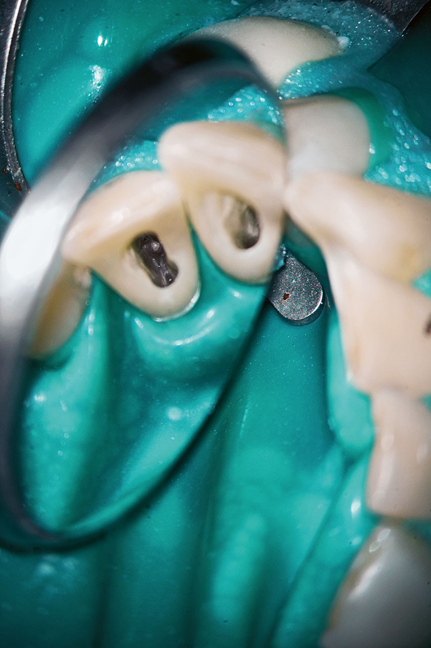 Abb. 3 Aufgrund des ovalen Wurzelquerschnitts unterer Inzisivi existieren je ein vestibulärer und ein oraler Wurzelkanal, die im orthoradialen Strahlengang hintereinander liegen.