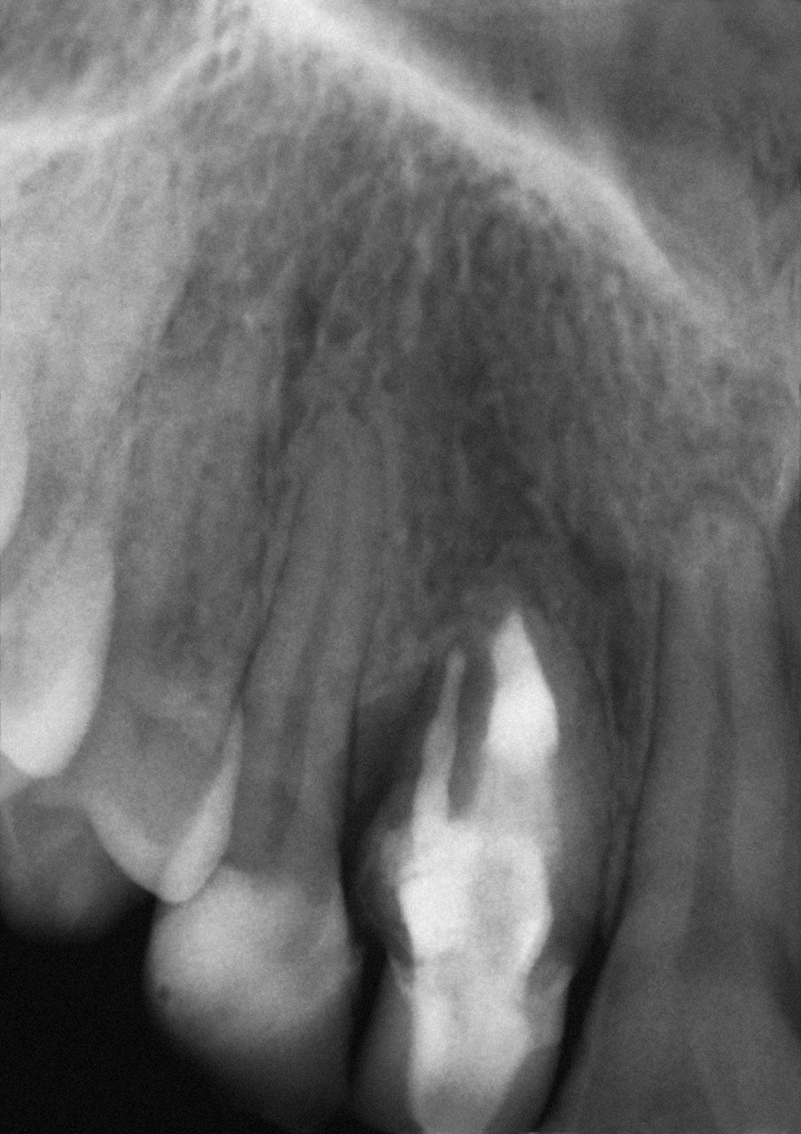 Abb. 8 In vielen Fällen muss neben der Invagination auch das Wurzelkanalsystem endodontisch behandelt werden.