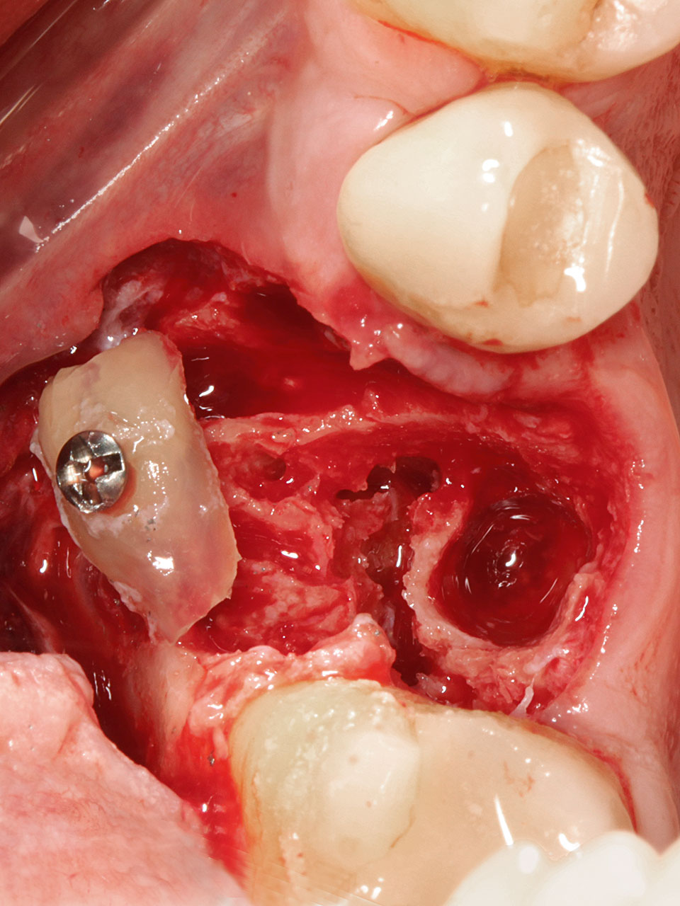 Abb. 3a Separierte Zahnwurzel aus dem nicht erhaltungswürdigen Zahn 16 und simultane Transpositionierung zur Augmentation vestibulärer Dehiszenz­defekte.