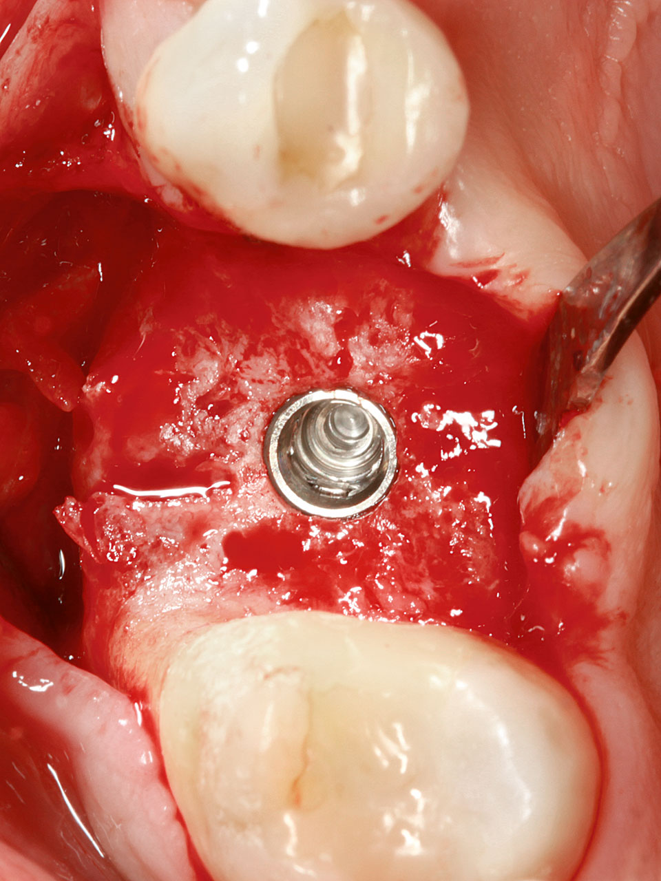 Abb. 3d Chirurgische Wiedereröffnung mit nachweisbarer – fast vollständiger – Ersatzresorption der transpositionierten Zahnwurzel und deutlicher Zunahme der Kieferkammbreite, was eine regelrechte Implantatinsertion ermöglichte.
