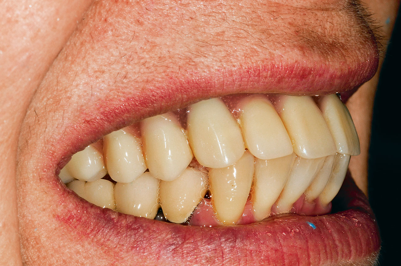 Abb. 1 Vorhandener Zahn­ersatz. Konventionelle Prothese im zahnlosen Oberkiefer.