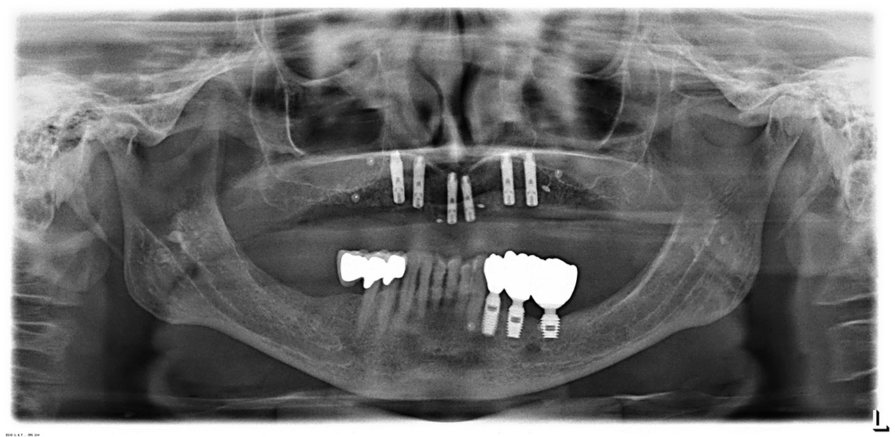 Abb. 2 Röntgenkontrollbild nach der Einheilung der sechs Implantate im Oberkiefer.