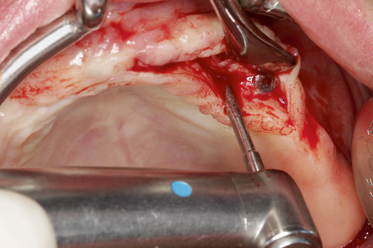 Abb. 3 Freilegen der Implantate nach der Einheilung.
