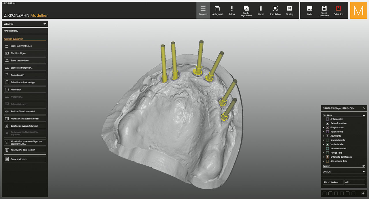 Abb. 5 Darstellung der Implantatachsen in der CAD-Software.