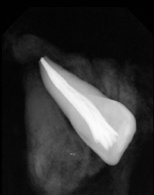 Abb. 24: Einzelzahnröntgen wurzelkanalbehandelter avulsierter Zahn (Schneider [3])