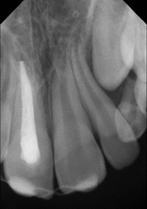 Abb. 25: Einzelzahnröntgen eines avulsierten Zahns nach erfolgter Wurzelkanalbehandlung und Schienung (Schneider [3])