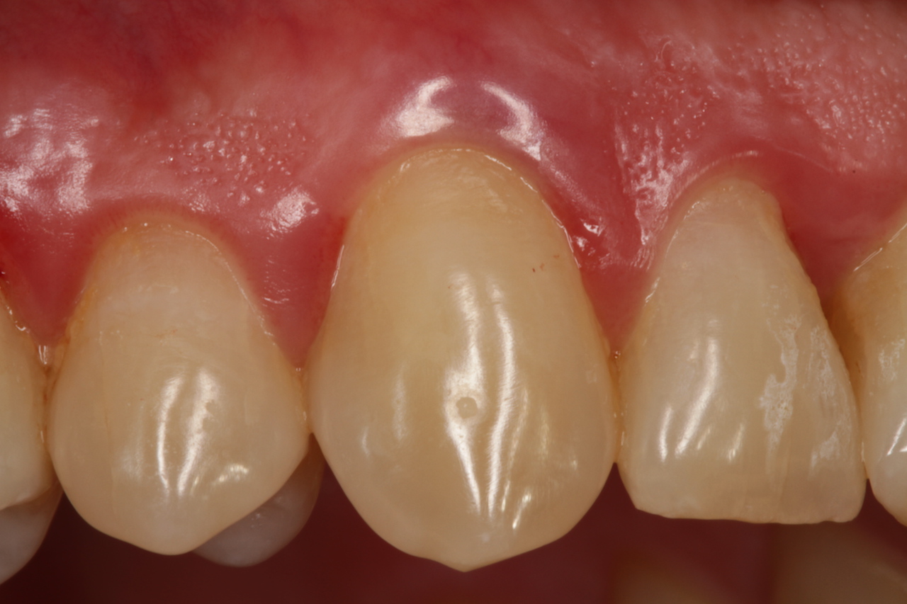 Abb. 3: Klinischer Ausgangsbefund Zahn 13 nach erfolgter PAR-Vorbehandlung.