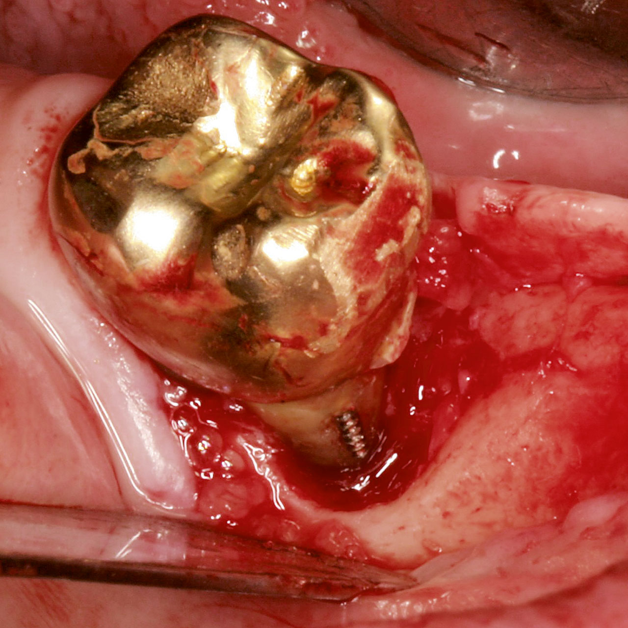 Abb. 2 Verletzung der biologischen Breite durch Wurzelstiftperforation mit zirkulärer Resorption des Alveolarknochens.
