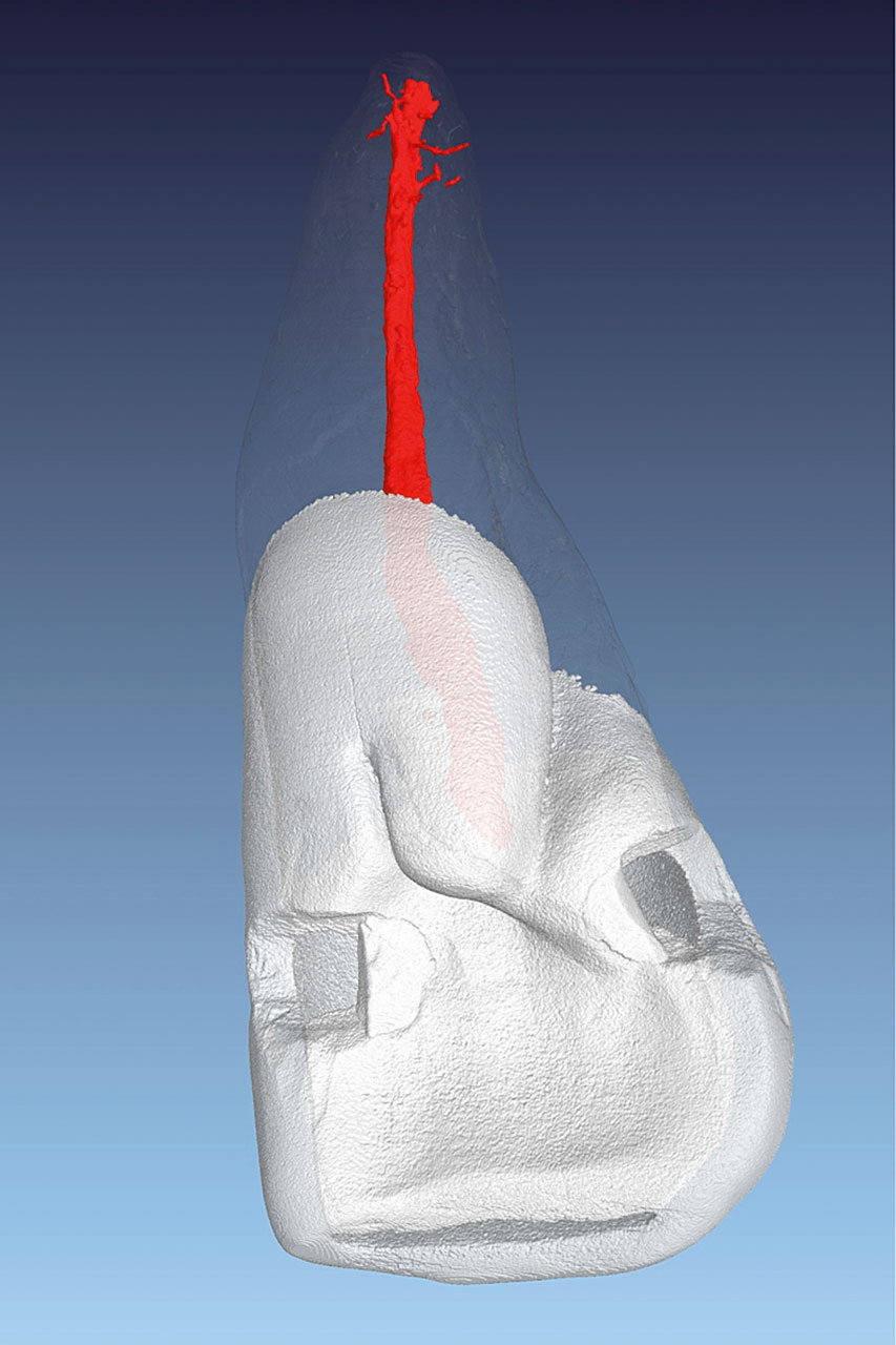 Abb. 2a Am Zahn 11 ist auf der dreidimensionalen Rekonstruktion eine distale Wurzelfurche bis in das mittlere Wurzeldrittel zu erkennen. Rekonstruktion mit angefärbtem Wurzelkanalsystem.