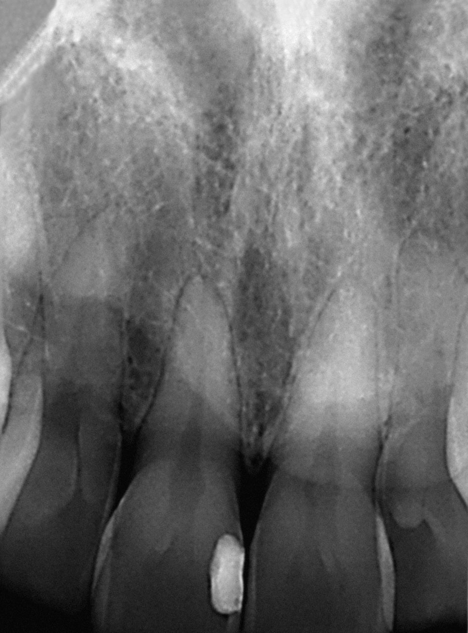 Abb. 3 Am Zahn 12 lässt sich eine Wurzelfurche erkennen. Die vertikale Ausdehnung ist nur zu vermuten. 