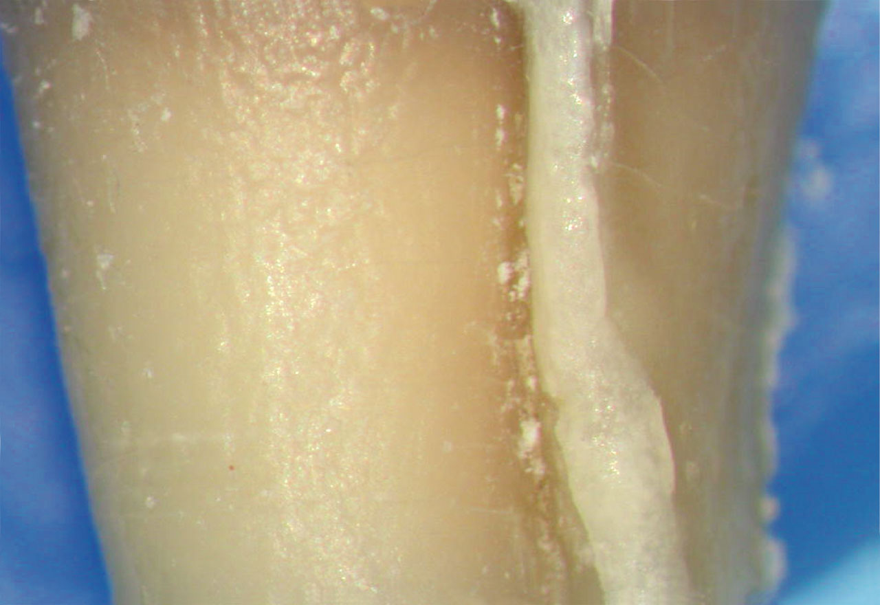 Abb. 4 Schmelzähnliche Struktur entlang der Wurzelfurche, die einen verstärkten Röntgenkontrast erwarten lässt.