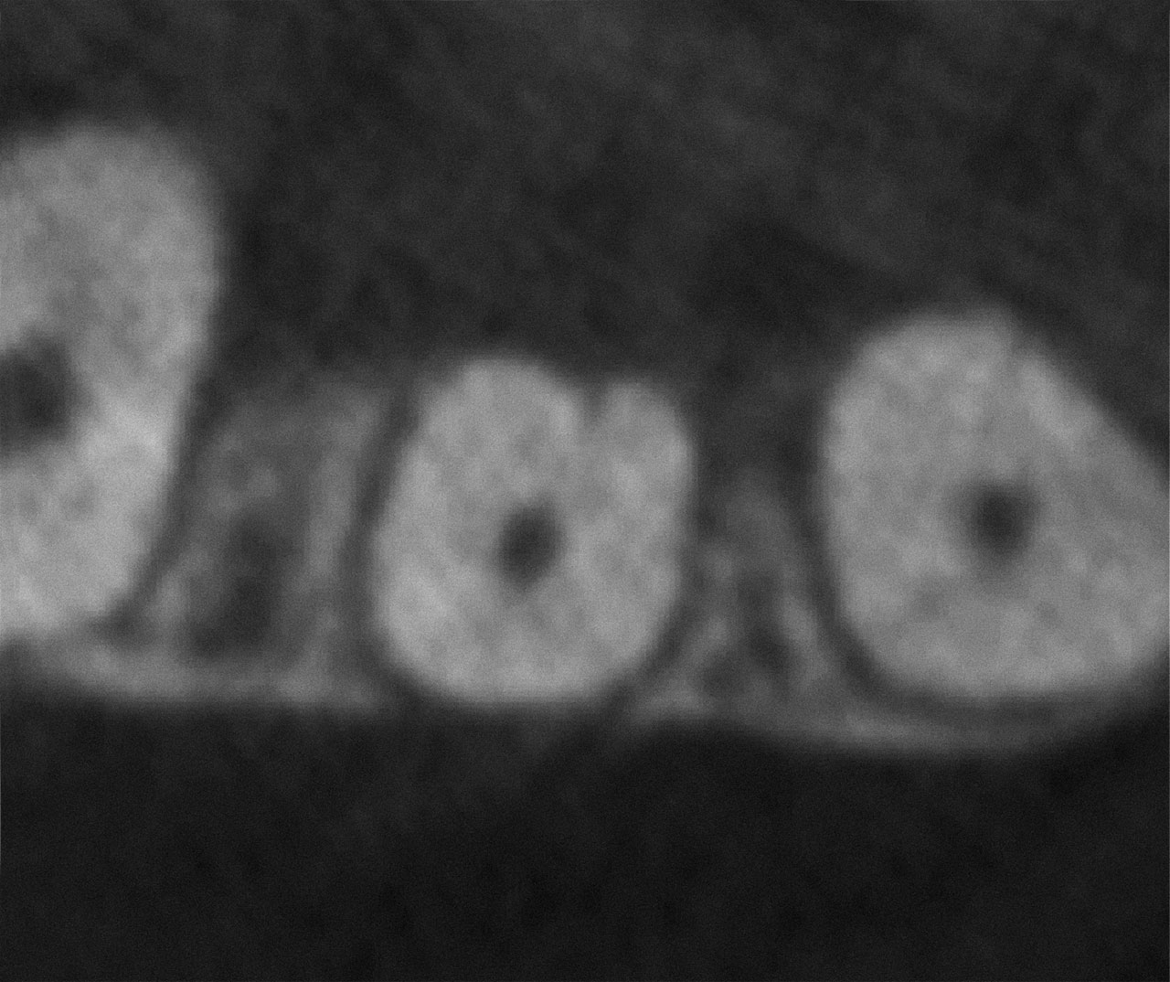 Abb. 7 DVT-Aufnahme von Zahn 12 mit einer Wurzelfurche Grad 1. Axiale Ebene bis in das mittlere Wurzeldrittel, ...
