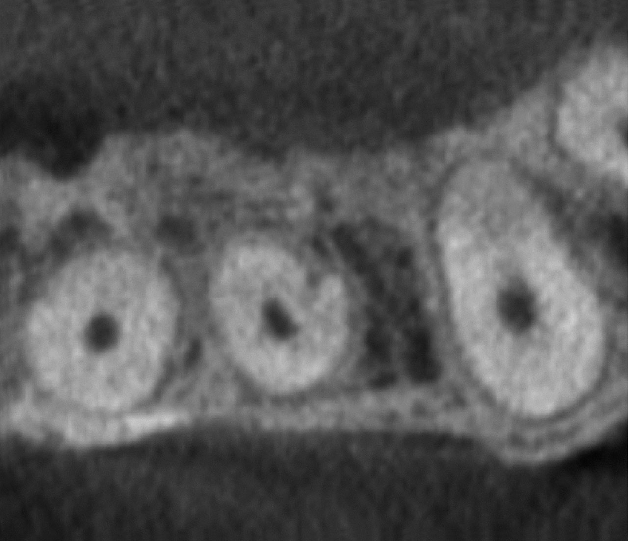 Abb. 10 DVT-­Aufnahme von Zahn 22 mit Wurzelfurche Grad 2. Axiale Ebene mit Wurzelfurche ohne Aufteilung des Wurzelkanals, ...