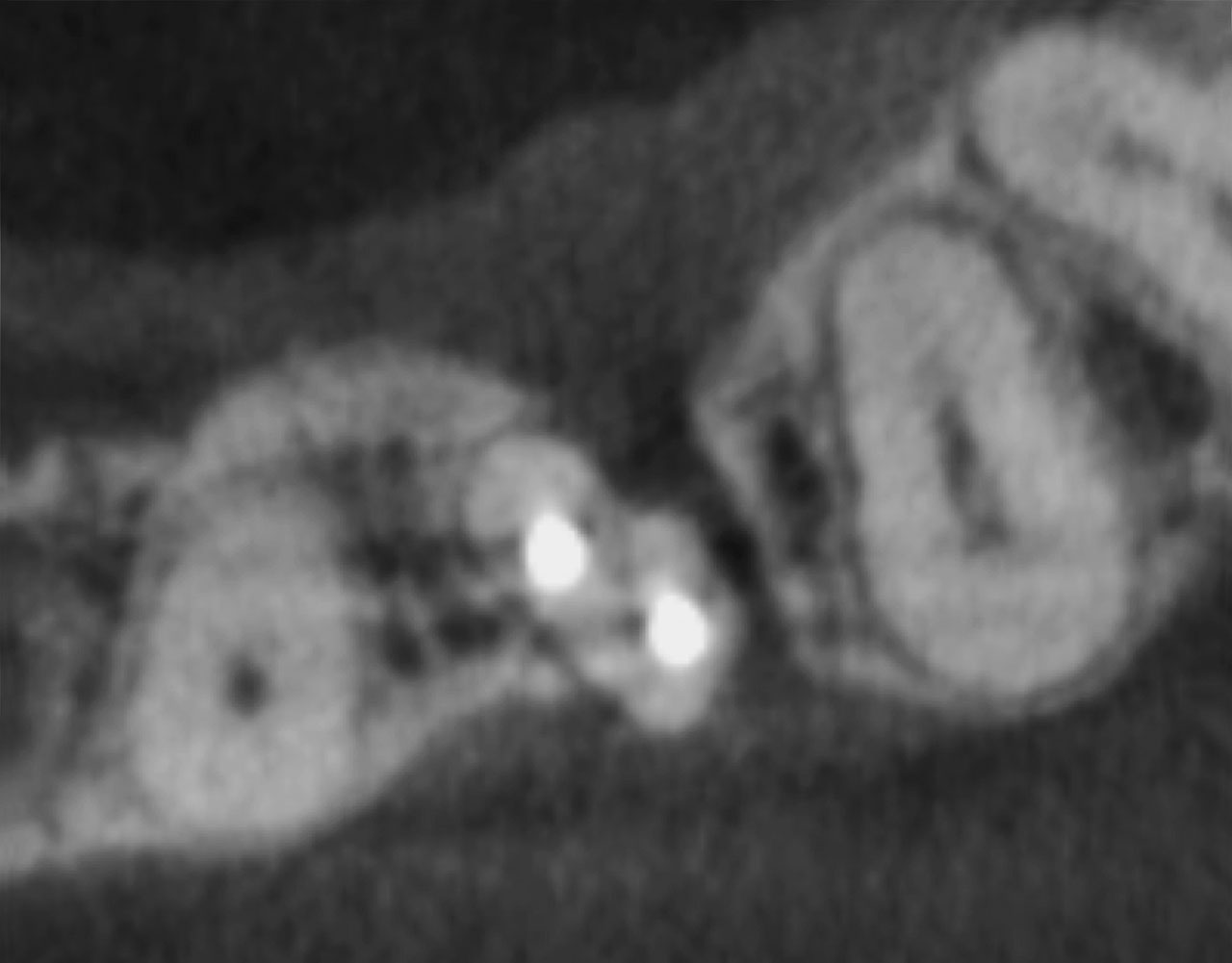 Abb. 12 DVT-­Aufnahme von Zahn 22 mit Wurzelfurche Grad 3. Axiale Ebenen mit bis nach apikal reichender Wurzelfurche und komplexer, sich teilender Wurzelkanal­anatomie, ...