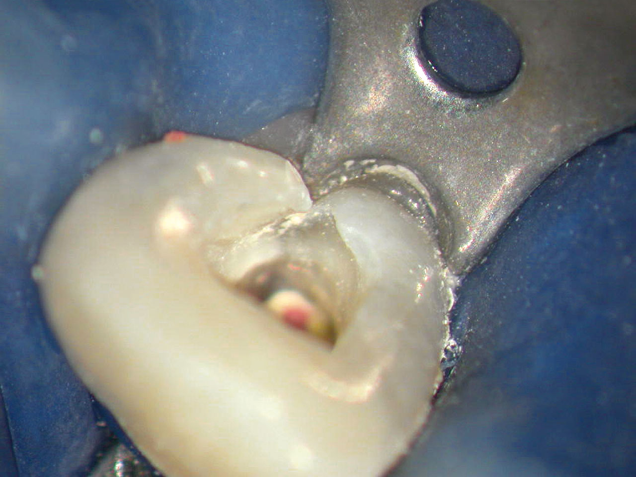 Abb. 17 Während der intrakoronalen Befundaufnahme und Diagnostik (IKD) ist kein Dentinriss zu erkennen.