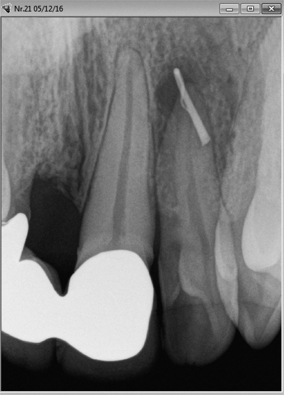 Abb. 19 Die Röntgenkontrastaufnahme eines Fistelkanals lässt eine apikale Parodontitis am Zahn 22 vermuten.