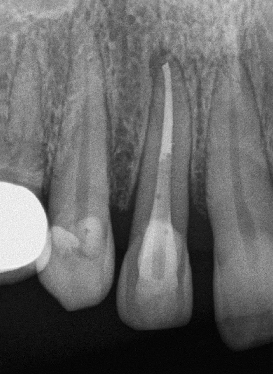 Abb. 29 Röntgenkontrolle nach Abschluss der endodontischen und parodontalen Therapie, ...