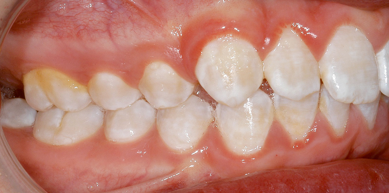 Abb. 4 Klinisches Bild einer Fluorose mit TF Score 3 nach Thylstrup und Fejerskov Index (TFI).