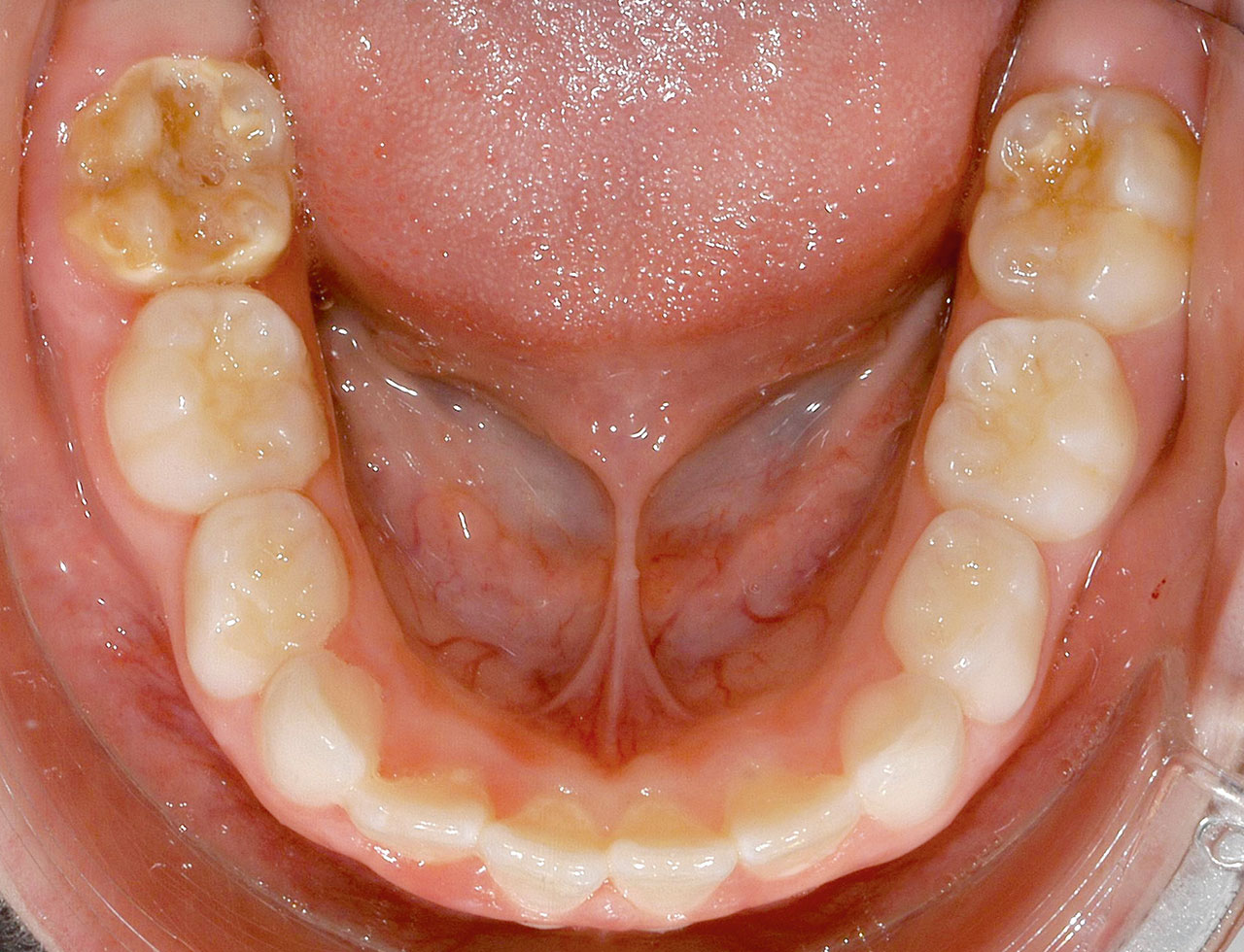 Abb. 6 Klinisches Bild einer Molaren- Inzisiven-Hypomineralisation mit unsymmetrischer Ausbildung; Zahn 36 mit Schweregrad 1 und Zahn 46 mit Schweregrad 2 nach Wetzel und Reckel<sup>24,17</sup>.
