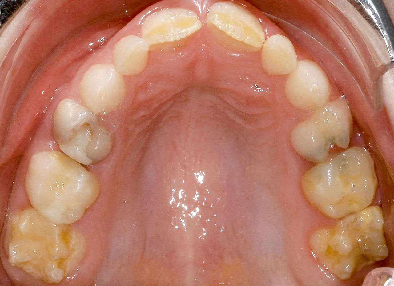 Abb. 7 Klinisches Bild einer Molaren-Inzisiven-Hypomineralisation mit deutlicher Veränderung der Kronenmorphologie der Zähne 26 und 16 gemäß Schweregrad 3 nach Wetzel und Reckel<sup>24,17</sup>.