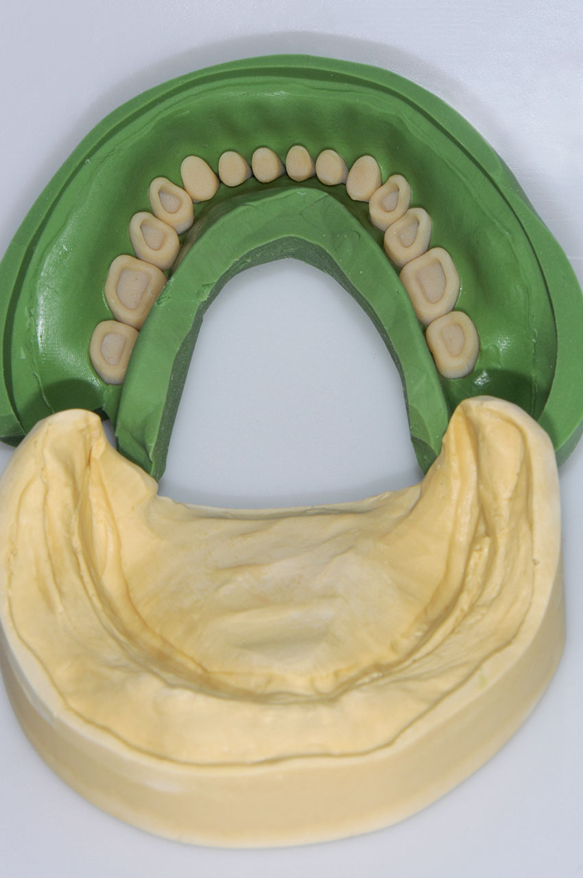 Abb. 2 Gesäubertes Unterkiefermodell und Silikonschlüssel mit aufgerauten Zähnen, vorbereitet zum Einlaufen des Kunststoffes.