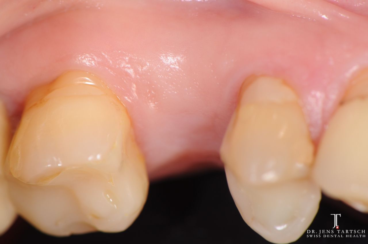 Klinische Ausgangssituation, Zahn 14 soll mit einer Vollkeramikkrone versorgt werden