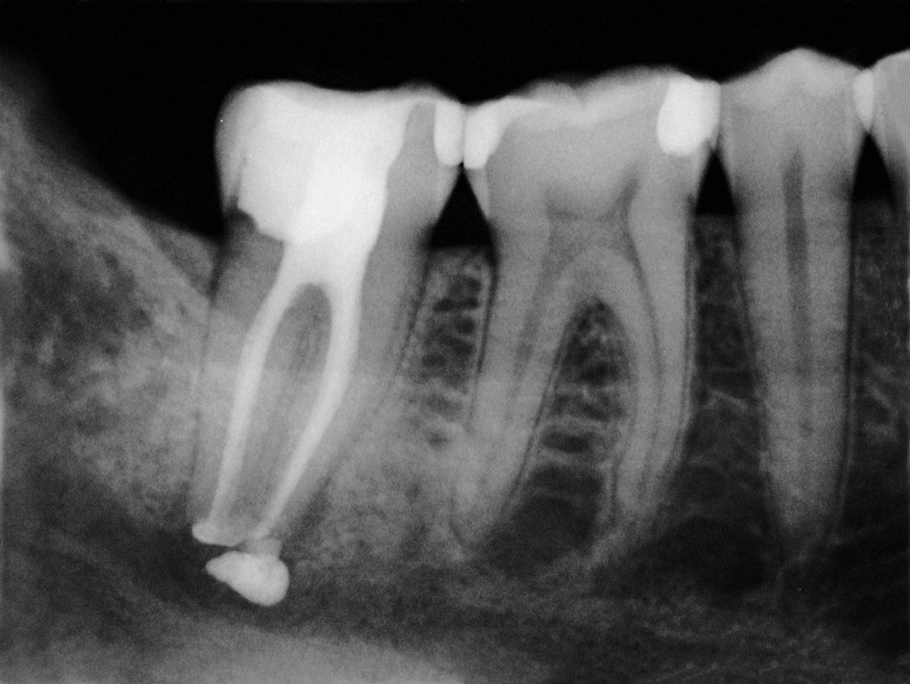 Abb. 2 Einzelzahnröntgenbild mit überstopftem Wurzelkanal­füllmaterial an Zahn 47.