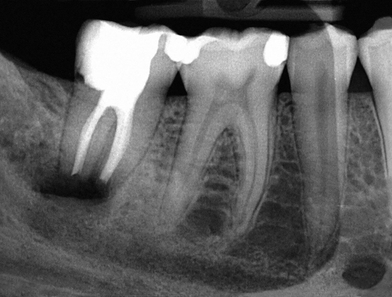 Abb. 8 Postoperatives Einzelzahnröntgenbild nach Wurzelspitzenresektion an Zahn 47 und Entfernung des überstopften Füllmaterials.