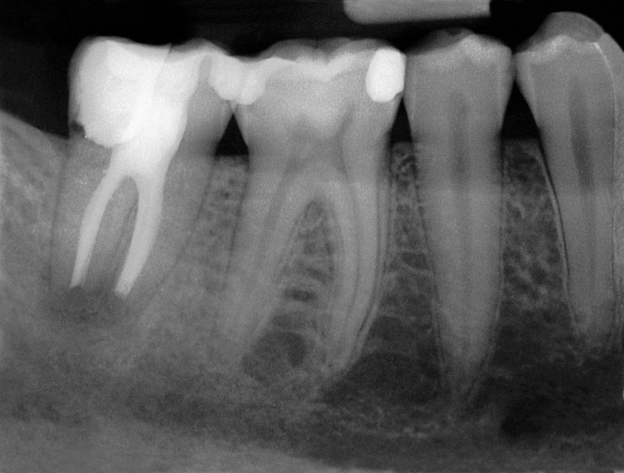 Abb. 9 Einzelzahnröntgenbild 6 Monate nach Wurzelspitzen­resektion an Zahn 47 und Entfernung des überstopften Füllmaterials.
