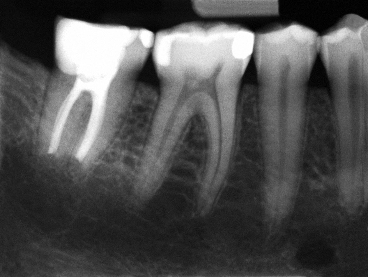 Abb. 10 Einzelzahnröntgenbild 12 Monate nach Wurzelspitzenresektion an Zahn 47 und Entfernung des überstopften Füllmaterials.