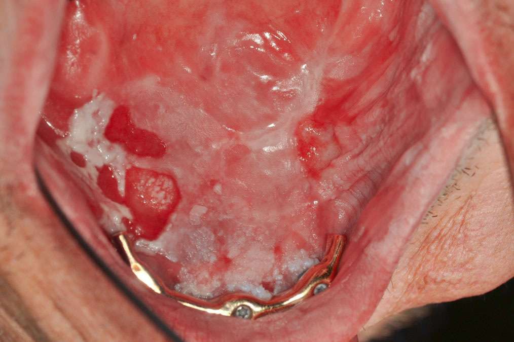 Abb. 5 Graft-versus-Host Disease nach allogener Stammzelltransplantation und chronisch myeloischer Leukämie. Abwechselndes Bild lichenoider und ulzeröser Mundschleimhautveränderungen. Aufsicht Unterkiefer lingual.